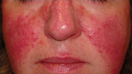 bd-hablamos-sobre-complicaciones-de-la-rosacea-250422