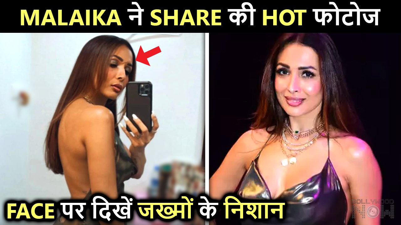 Malaika Arora Clicks A Hot Selfie, Injury Scars Visible After Accident