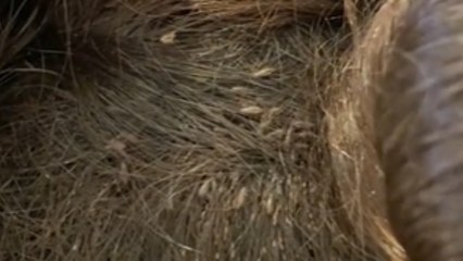 Así habitaban miles de piojos en la cabeza de una niña de  años