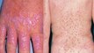 Skin से जुड़ी Lichen Planus बीमारी है खतरनाक,जानिए इसके लक्षण और कारण । Boldsky