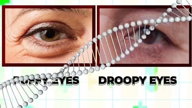 How Blepharoplasty is performed Eyelid surgery