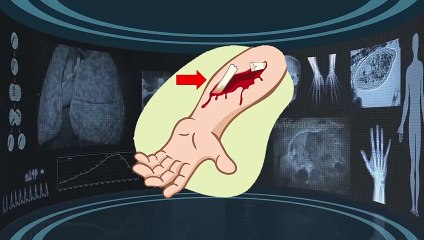 Common types of Bone fracture