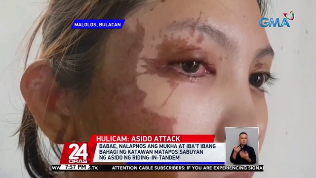 Babae, nalapnos ang mukha at iba't ibang bahagi ng katawan matapos sabuyan ng asido ng riding-in-tandem | 24 Oras
