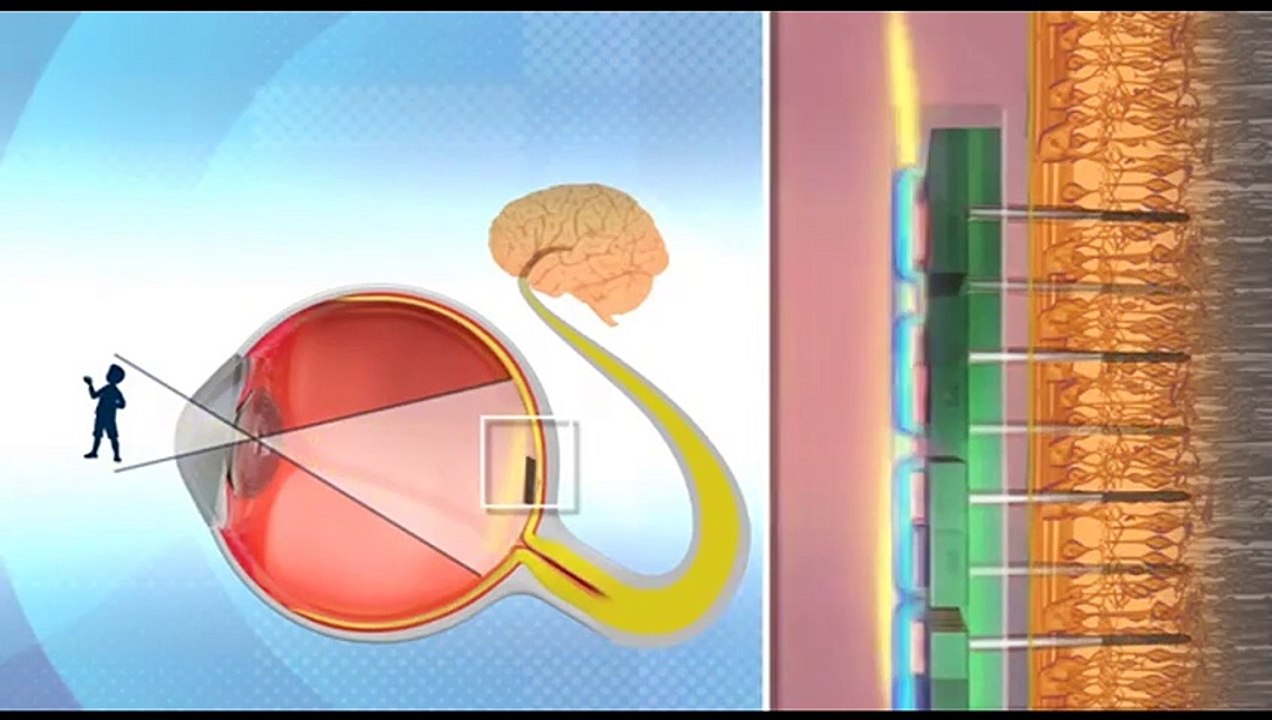 Бионический глаз которому позавидует человек – Видео Dailymotion