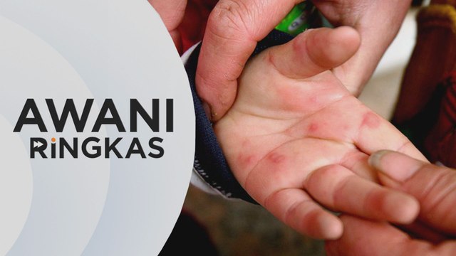 AWANI Ringkas: Kes HFMD di Selangor lepasi paras amaran