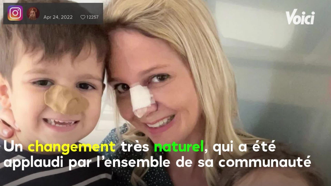 VOICI : Ambre Dol (Familles nombreuses) : opérée du nez, elle dévoile le résultat aux internautes