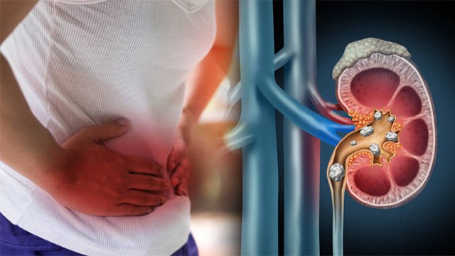 किडनी में गांठ क्यों होती है | किडनी में गांठ का इलाज | Kidney Me Ganth Hone Ka Karan | Boldsky