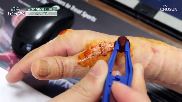 골절 수술 후에도 지속된 불편함 원인은 골다공증 TV CHOSUN 20220430 방송