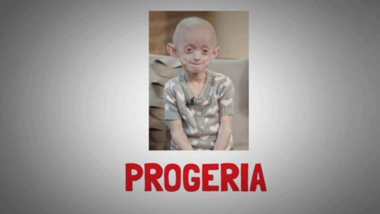Progeria (Hutchinson-Gilford syndrome): Genetic disorder