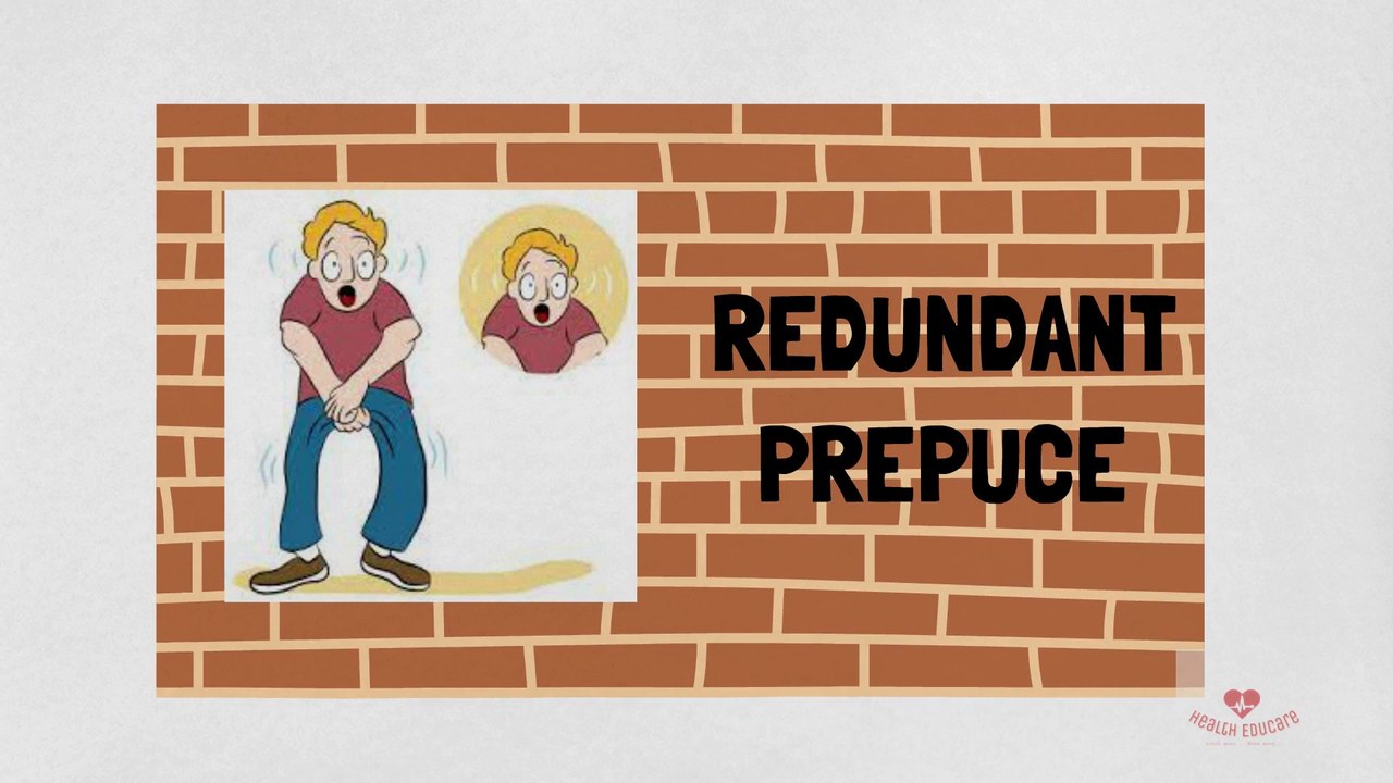 Redundant Prepuce: Excess foreskin on your glan