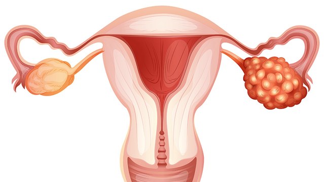 bd-cancer-de-ovario-sintomas-y-posibles-tratamientos-060522