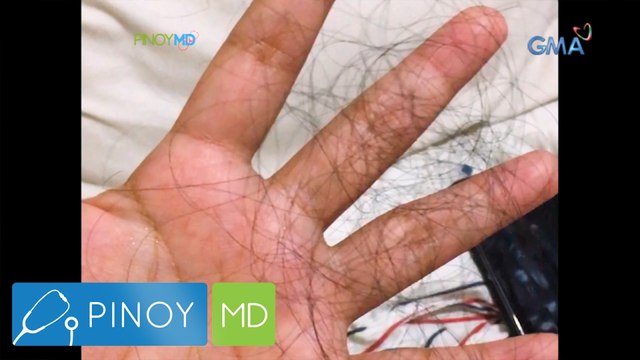 Sobra-sobrang paglulugas ng buhok, ano ang dahilan? | Pinoy MD