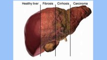 bd-hablamos-sobre-complicaciones-de-hepatitis-b-causas-y-tratamientos-090522