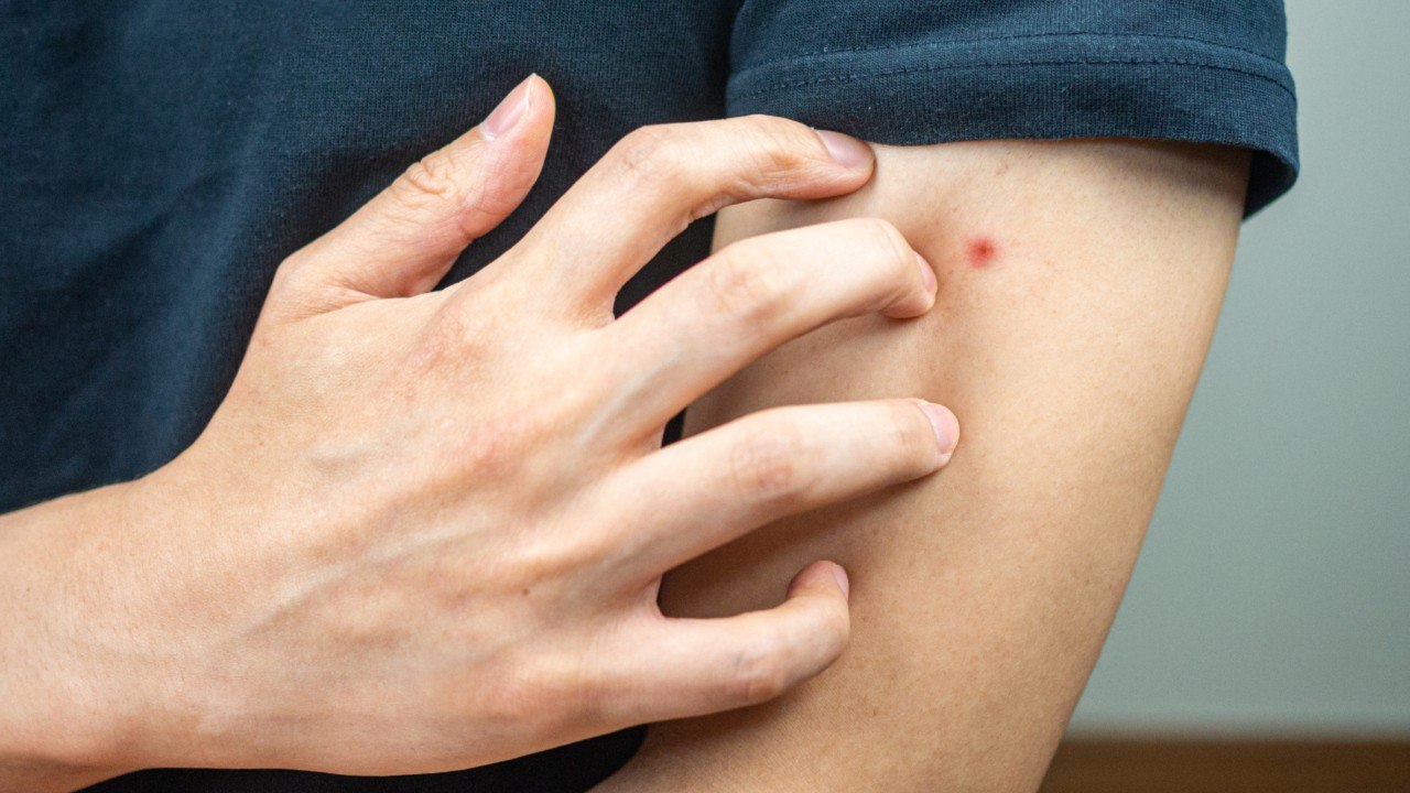 So sehen Bettwanzenbisse aus