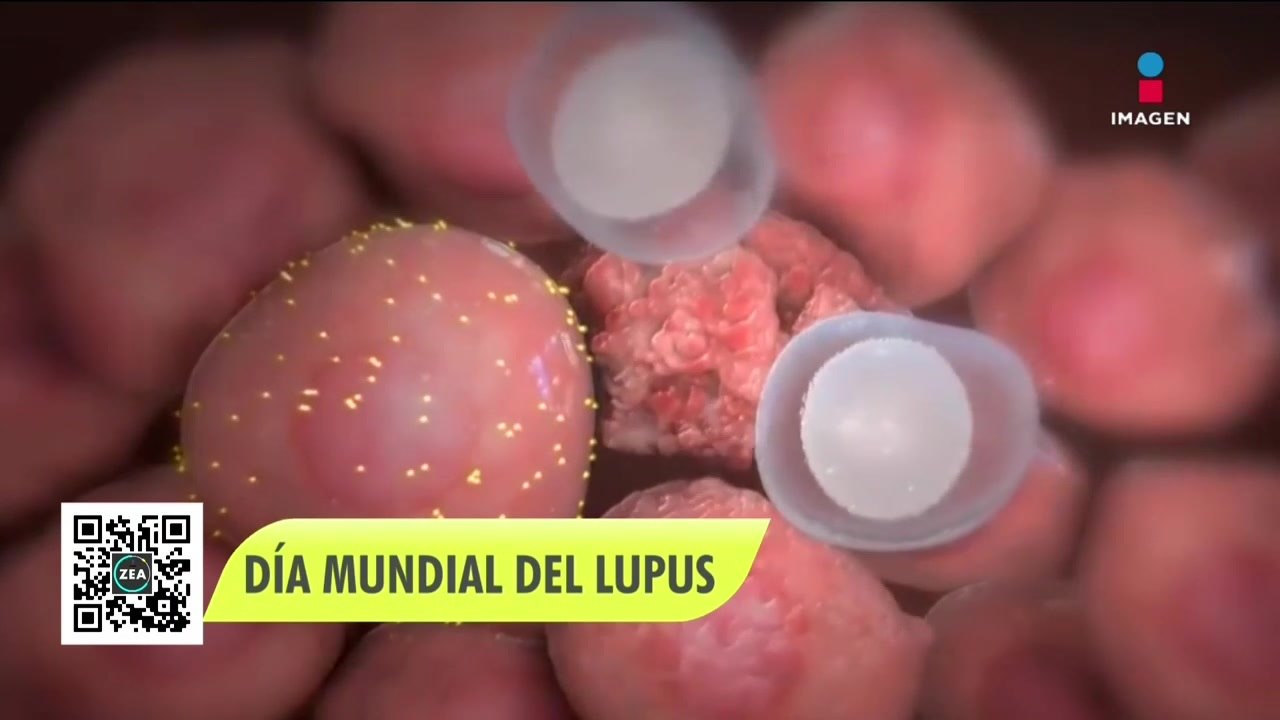 Lupus: tipos, síntomas y tratamiento