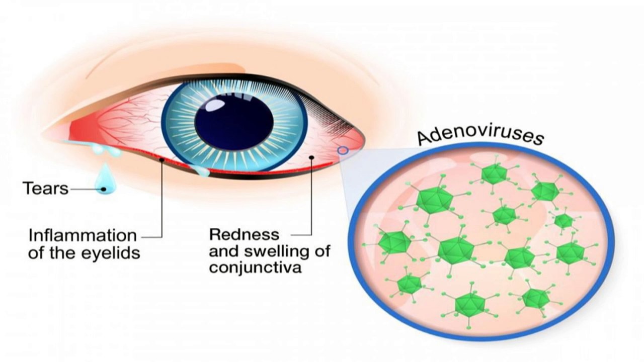 HOUSE CALL: CONJUNCTIVITIS