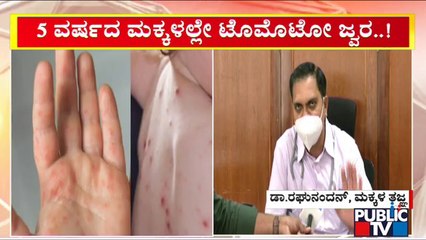 Tomato Fever : Doctors Explain About The Precautions To Be Taken | Public TV