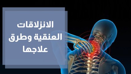 الانزلاقات العنقية وطرق علاجها