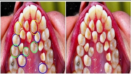 Hyperdrontia: I have Extra teeth  problem - Supernumerary teeth