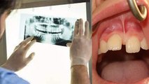 दांतों के बीच गैप Diastema बीमारी का कारण | दांतों के बीच गैप को कैसे ठीक करें | Boldsky