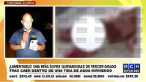 Menor sufre quemaduras de tercer grado en Catacamas, Olancho