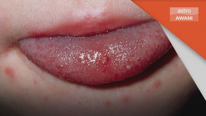 Jangkitan HFMD | Selangor sudah melepasi tahap amaran