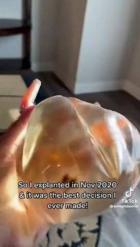 Modelo muestra implantes de senos con moho; asegura que se los quitó porque le causaron enfermedades