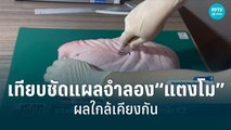 “หมอธวัชชัย” ทำคลิปใช้มีดพับจำลองเทียบแผล