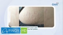 Stretch marks matapos magbuntis, paano ba mawawala? | Pinoy MD