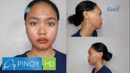 Ano ba ang solusyon sa acne problems? | Pinoy MD