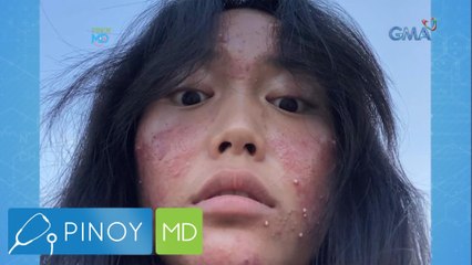 Cystic acne, paano kaya maiiwasan? | Pinoy MD
