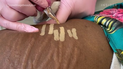 Treatment Permanently Camouflages Stretch Marks