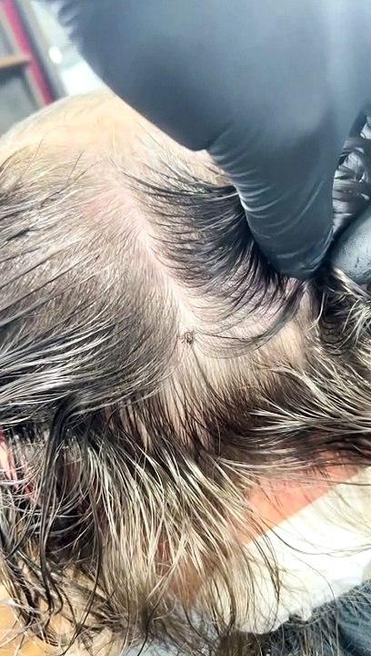 Removing a Tick From a Client's Head