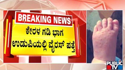 Tomato Flu Suspected In 4 Year Old Child In Udupi | Public TV