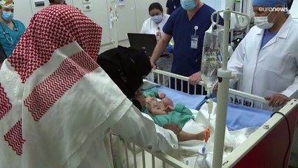 شاهد: أطباء سعوديون يجرون بنجاح عملية "معقدة" لفصل توأمين يمنيين سياميين
