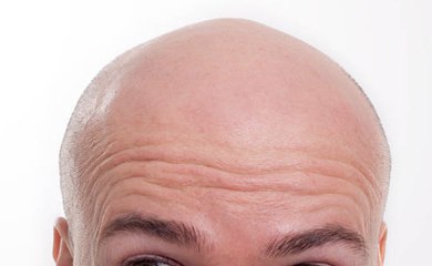 Traiter un homme de "chauve" équivaut à du harcèlement sexuel selon un juge britannique