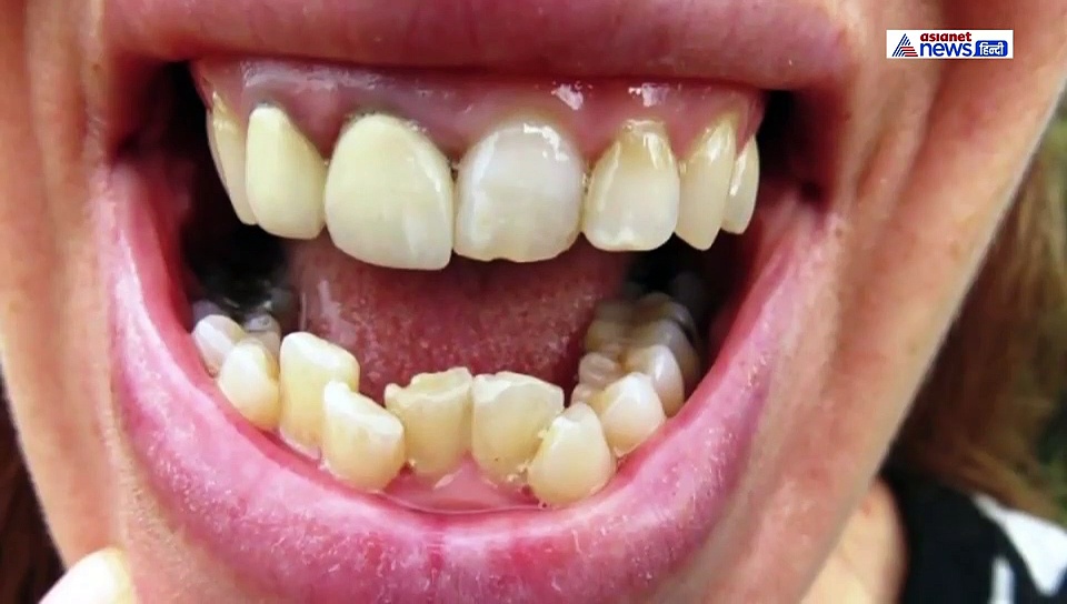 जिस व्यक्ति के दांतों में होता है गैप...वो होता है भाग्यशाली, जानें क्या कहते हैं आपके दांत