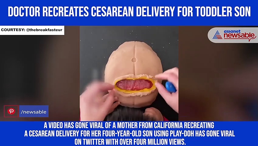 Doctor recreates Cesarean delivery for toddler son