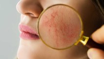 Rosacea: Was steckt hinter der Hautkrankheit?