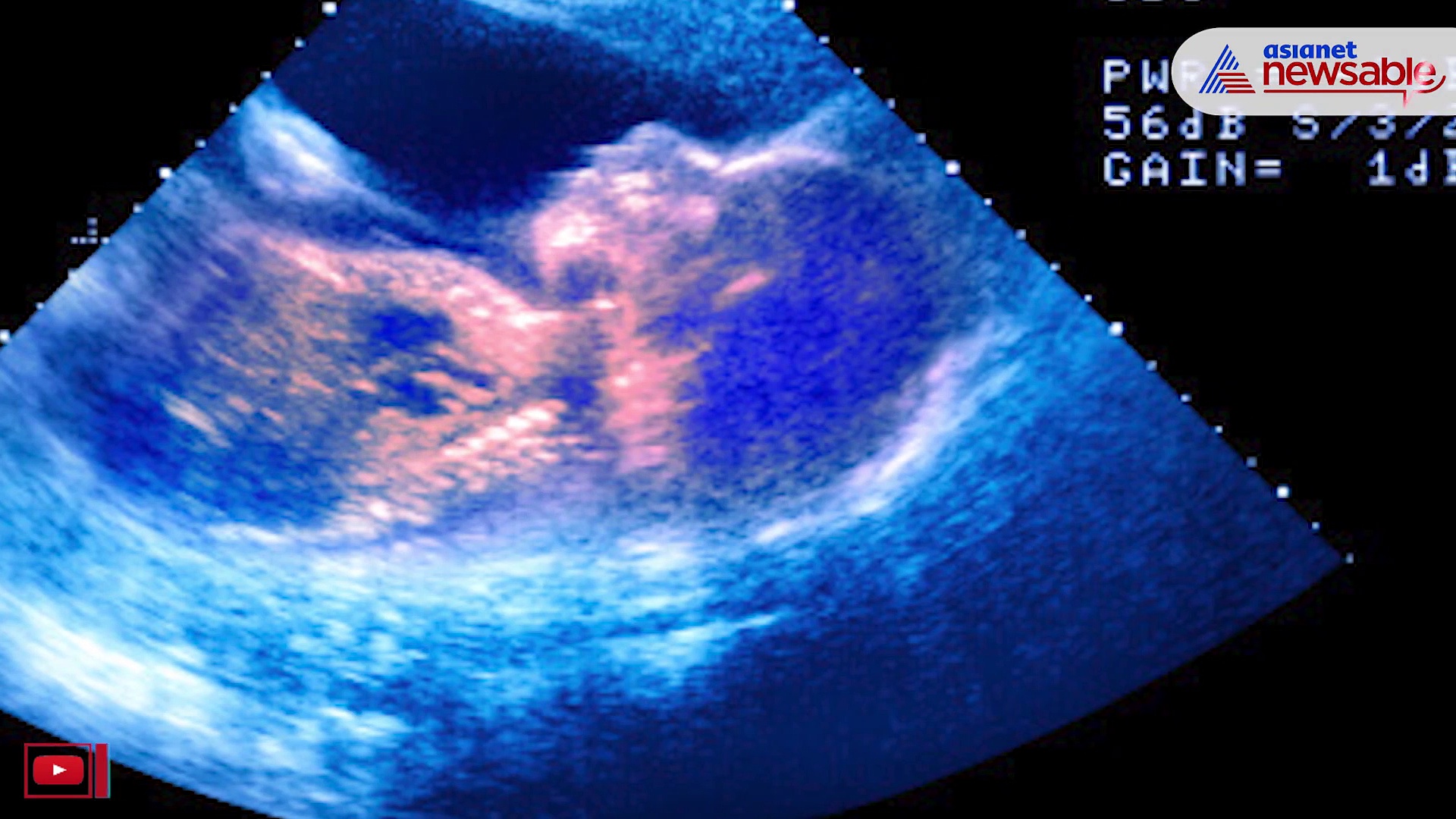 World IVF Day: Dos and don'ts of the process; know some truth about IVF treatment