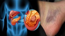 पैरों पर ये निशान Pancreatic Cancer का Symptom, Blood Clot होते ही क्या करें | Boldsky