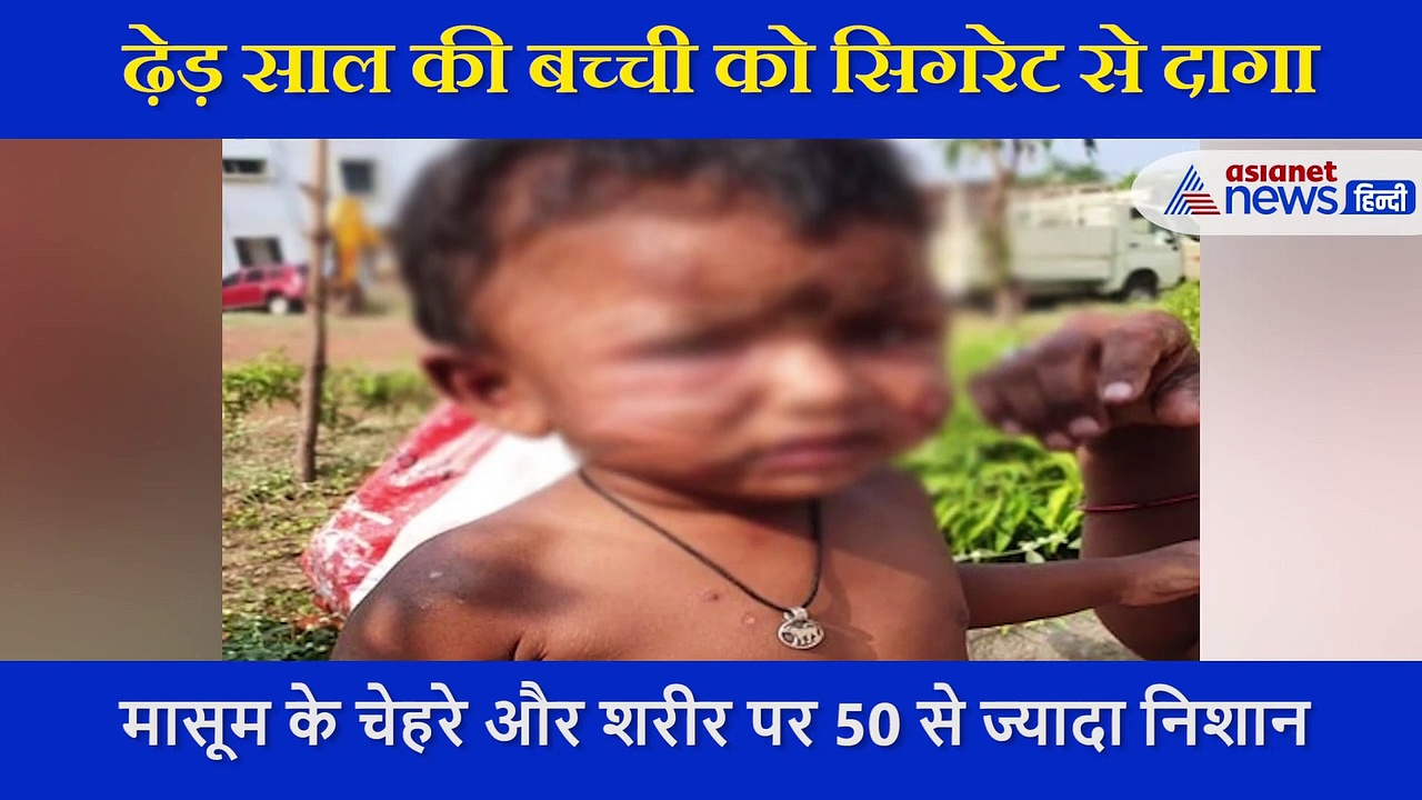 नशे में धुत पुलिसकर्मी ने ढ़ेड साल की बच्ची को सिगरेट से दागा, चेहरे और शरीर पर 50 से ज्यादा जलने के निशान