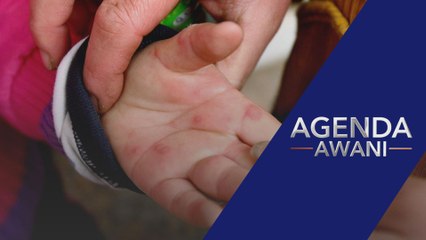 Apa itu HFMD & bagaimana mengendalikannya