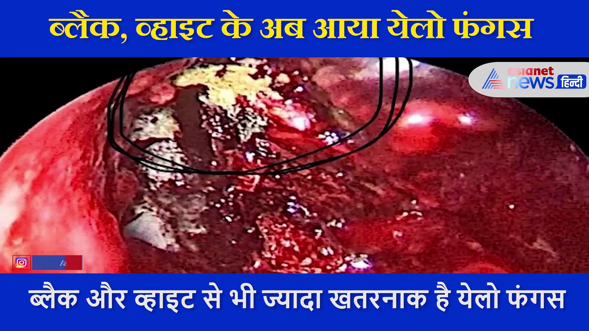 ब्लैक, व्हाइट के बाद आया येलो फंगस, जानें लक्षण और बचाव