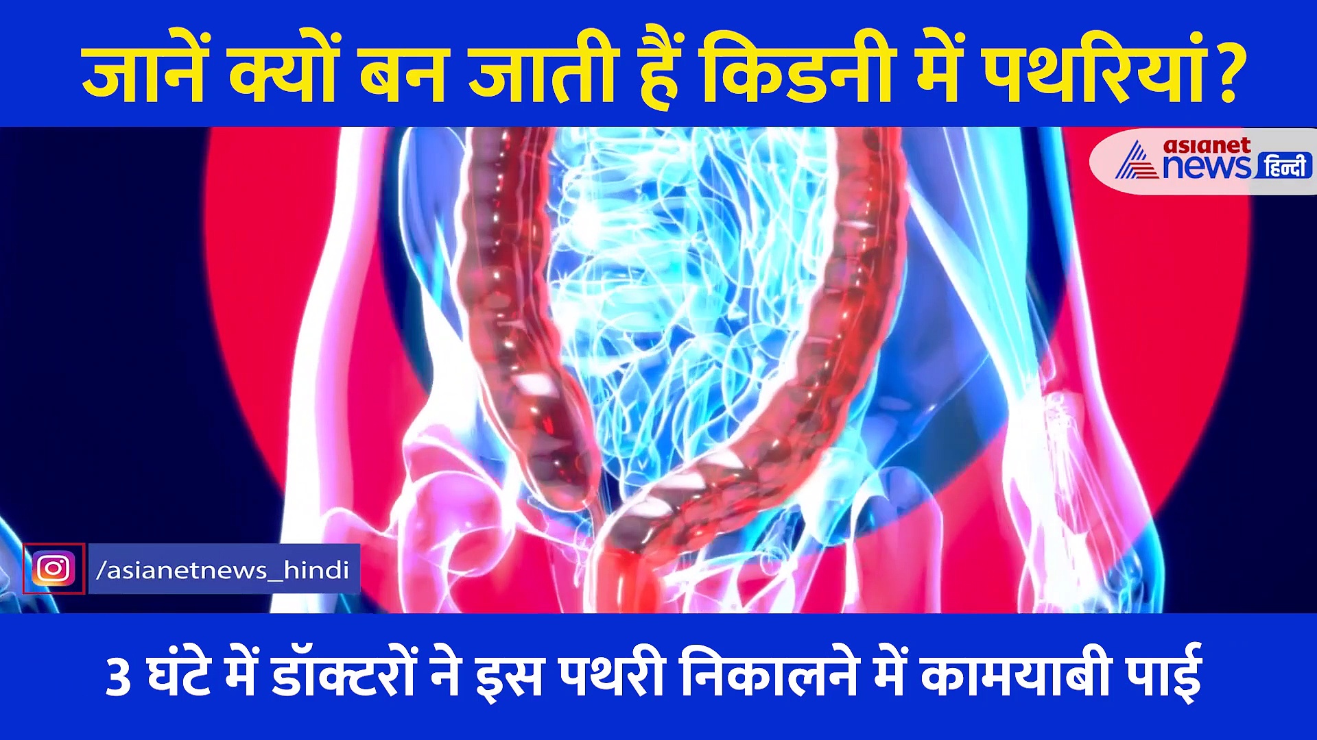 शख्स की किडनी से निकली 150 पथरियां, जानें क्यों बन जाते हैं स्टोन... क्या हैं लक्षण और बचाव