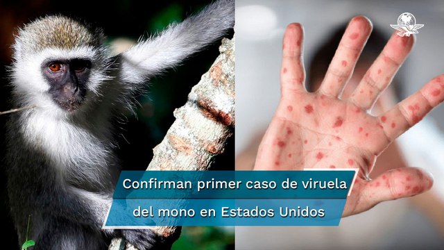 Viruela del mono llega a América: confirman primer caso en EU y 13 sospechosos en Canadá