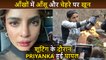 OMG Priyanka Chopra INJURED While Working, Shows Off Her Scars