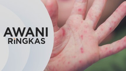 AWANI Ringkas: Sabah catat peningkatan 51 kali ganda kes HFMD