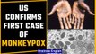 Monkeypox cases detected in US, UK & parts of Europe |Know all about Monkeypox virus |Oneindia News
