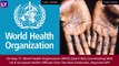 US Confirms First Case Of Monkeypox After Cases In UK, Spain, Portugal: Symptoms, How Does It Spread